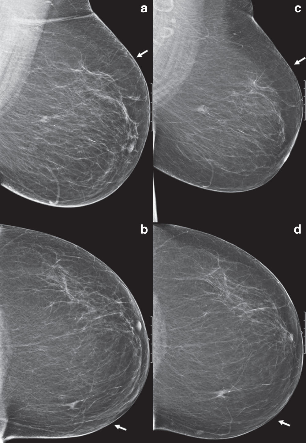 6 mitos de la mamografía