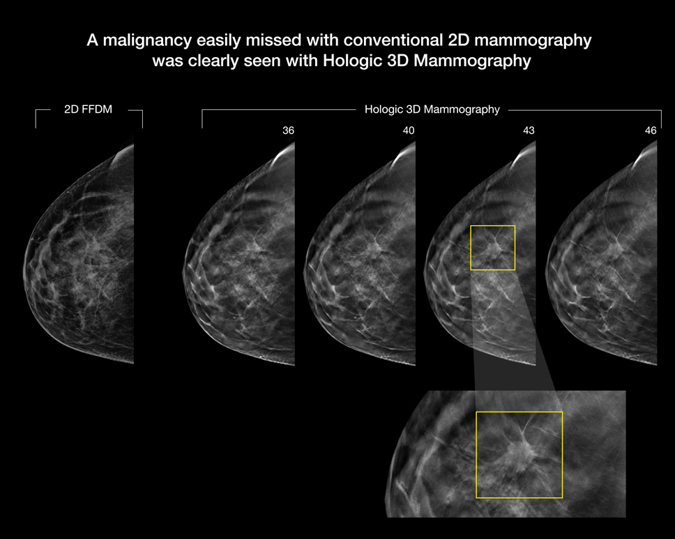 ¿Qué es una mamografía?